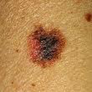 Malignant Melanoma